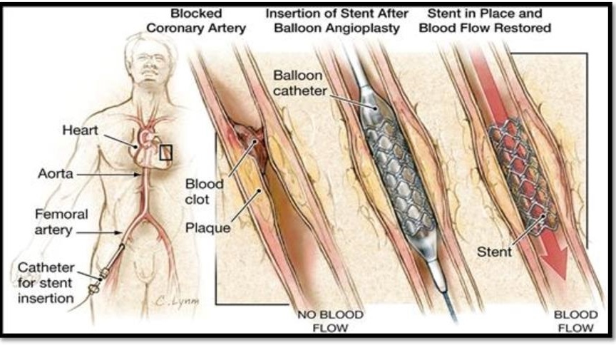 Insertion of Stent After Balloon Angioplasty