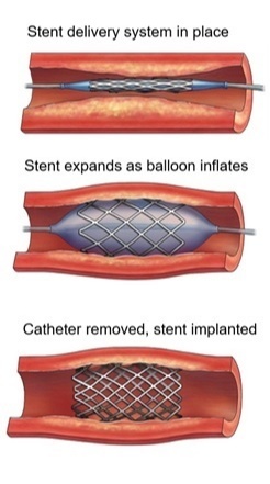 stents