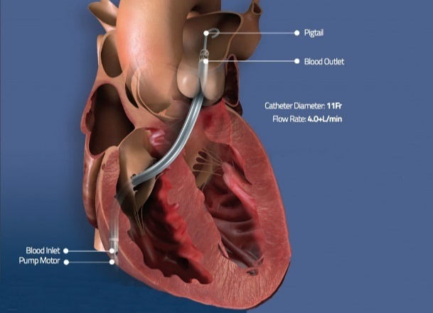 Injection of Impella