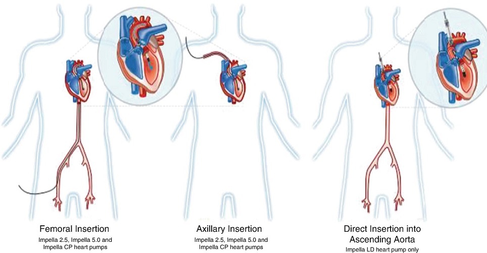 Axillary Artery in the Ahoulder 