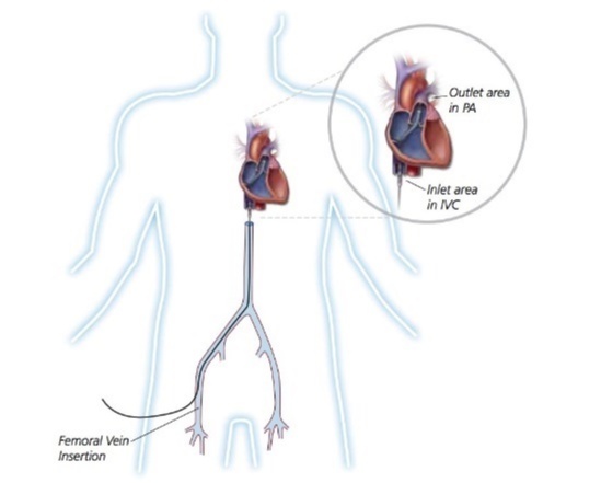 Axillary Injection of Impella