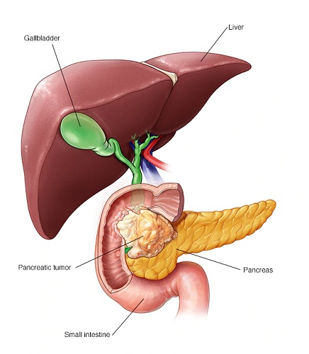 Pancreatic Cancer