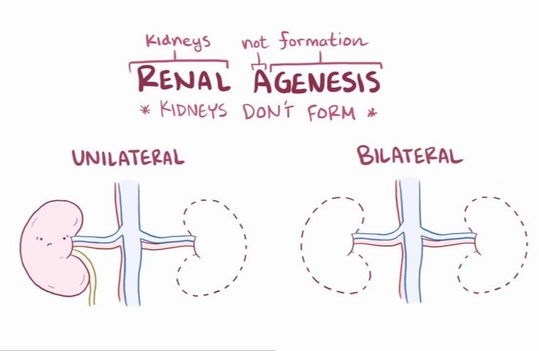 What Is Renal Agenesis