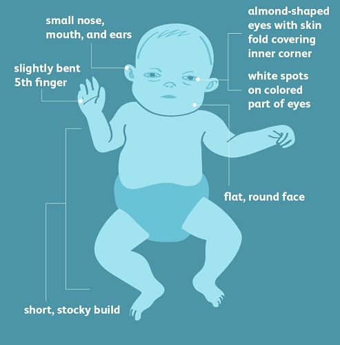 Down Syndrome Early the Detection, Quick the Treatment
