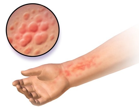 Eczema, a condition where the skin becomes inflamed and itchy due to a combination of genetics and environmental factors
