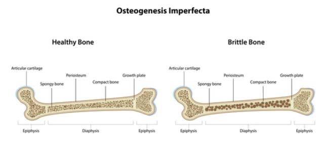 Not so many must have heard of Osteogenesis Imperfecta. It is a rare disease in which the victim suffers multiple bone fractures